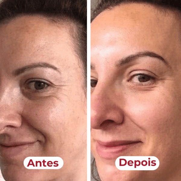 Antes e depois mostrando pele mais luminosa com Belli K Pelle